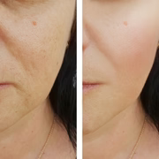 EXFOLIANT A L'ACIDE AZELAIQUE ET NOYEUX D'ABRICOT